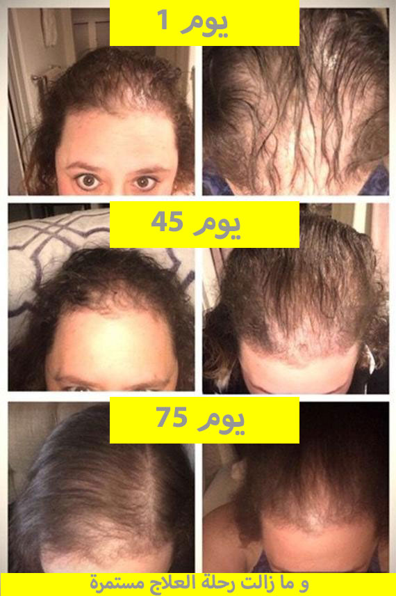نتائج-منتج-regain-لعلاج-تساقط-الشعر-للمرأة